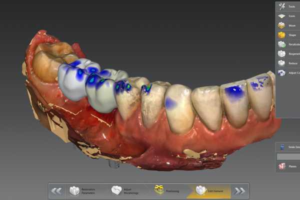 Komputerowy projekt koron protetycznych